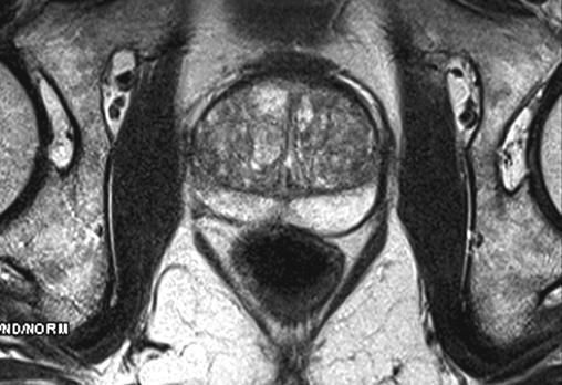 Lokal nüks hipervasküler yapısı nedeniyle kontrastlı BT de seçilebiliyor (D). Prostat kanserine bağlı multipl akciğer metastazları (E). reaktif mi? Yoksa metastatik mi?