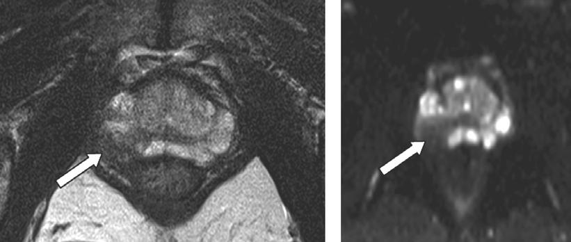 A B Şekil 4. Sağda periferik zonda tümöre ait hipointens görünüm (A). Aynı lezyon belirgin difüzyon kısıtlaması gösteriyor (B) Şekil 5.