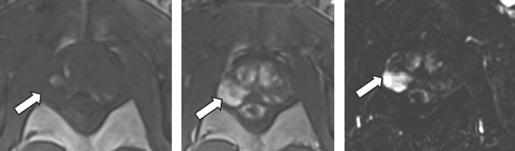 Şekil 6. Prostat bezine yönelik perfüzyon MRG de sağ periferik zonda parankime göre erken kontrastlanan tümör görülüyor (oklar) A B Şekil 7.
