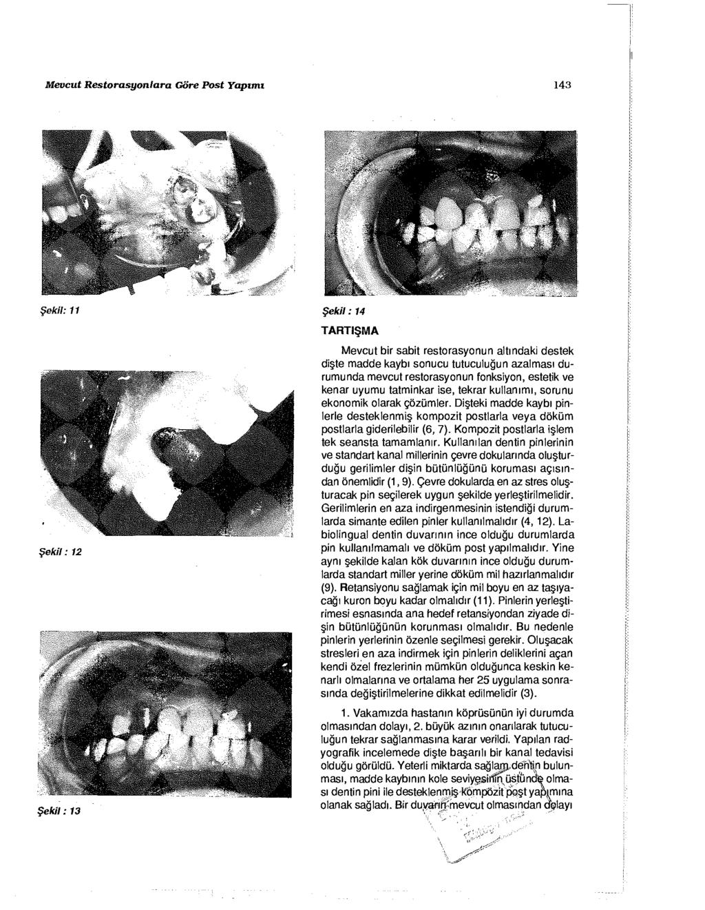 Mevcut Restorasyonlara Göre Post Yapımı 143 Şekil: 14 Şekil: 13 TARTİŞMA Mevcut bir sabit restorasyonun altındaki destek dişte madde kaybı sonucu tutuculuğun azalması durumunda mevcut restorasyonun