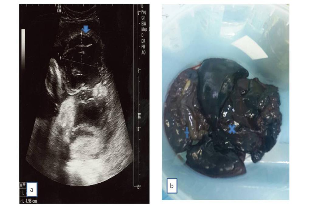 günde sorunsuz taburcu edildi. Resim 2. (a) plasenta kenarından başlayan subkoryonik hematom, kalın ok miyometriyumu, yıldız ise amniyon zarını göstermektedir.