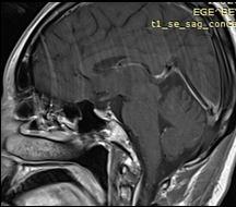 tedavisi: NCCN Guidelines