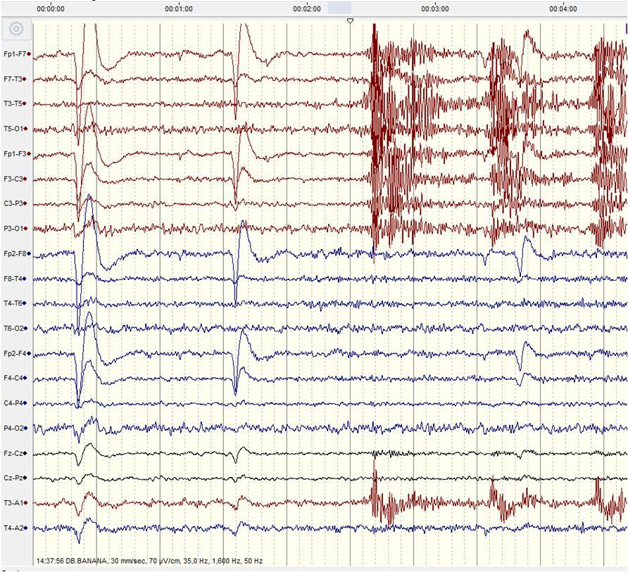 F.Ü. Sosyal Bilimler Dergisi 2014- Bayan Fotoğraf 10 Fotoğraf 11 Sigara görseli EEG deseni Çikolata görseli EEG Her iki ürününde tüketicisi olan bayan gönüllü her iki ürüne de beyninin sol yarım