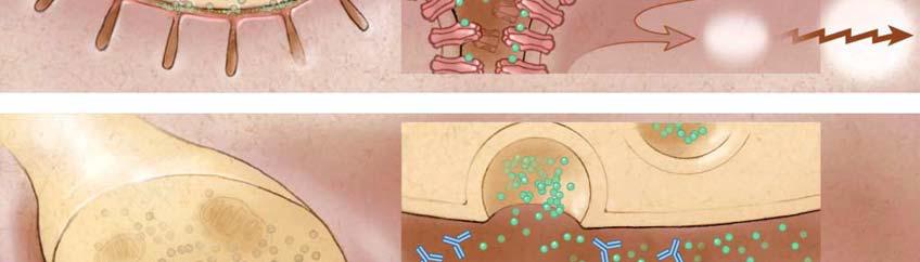 dekat erkeklerde pik Juvenil ve neonatal form Çoğunlukla idiyopatik Timoma%30-60 hastada mevcut Nöromusküler bileşkedeki postsinaptik asetilkolin reseptör proteinlerine immünolojik saldırı Simetrik