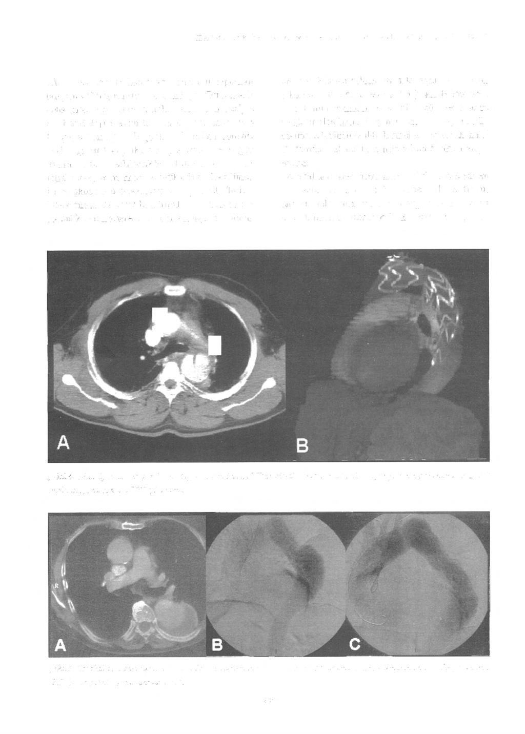 H Arbaılı ve ark: inen aort anevrizma ve d iseksi yonlarında endovasküler stent greft ile tedavi eden, çevresinde hematom oluşumu saptanan tampone olmuş ruptür tablosundaydı.