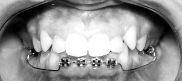 Intrüzyon Hareketi ve Gingival Cevap Intusive Movement and Gingival Response fiekil 3: Utility ark n a zda uygulan fl. Figure 3: Intraoral application of the utility arch.