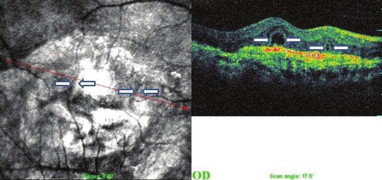 262 Yaşa Bağlı Maküla Dejeneresansında Dış Retinal Tübülasyonların Sıklığı ve Önemi a b c d Resim 1a-d: Dış retinal tübülasyon saptanan dört olguya ait OKT görüntüleri.