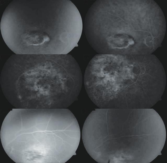 Topografi kesiti lezyonların olduğu retinal katmandan yatay ve dikey planda alınmıştır.