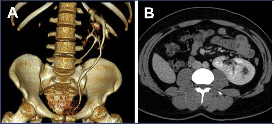 lik edebilir. Erkeklerde kriptoorşidizm ve vaz deferens yokluğu en sık görülen genital eşlik eden anomalilerdir.[11] 2009 yılında 209 füzyon anomalili hastada Glodny ve ark.