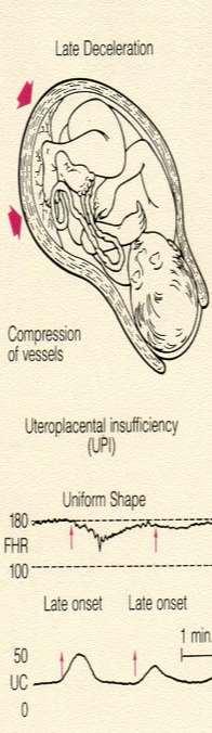 Geç Deselerasyon Kontraksiyon Mekanizma Uterin ve fetoplasental kan akımının azalması İntervilloz staz