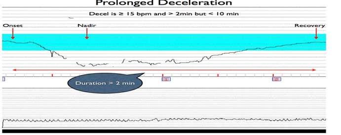 Uzamış deselerasyonlar: Bazalin en son belirenen noktasından itibaren FHR de belirgin bir çöküş olarak tanımlanır.