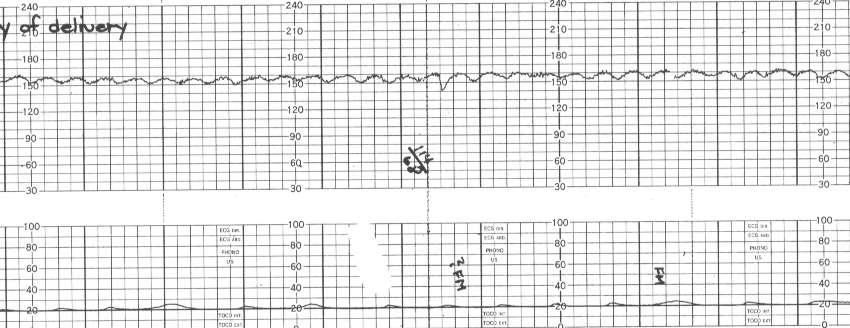 Sinuzoidal Pattern Özelliği Trase testere ağzı görünümündedir. Bazal hız 120-160v/dk. arasındadır.