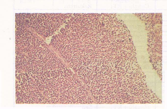 Her iki vakanın patolojik değerlendirilmesinde mikroskopide sinüs mukozası altında plazma hücresi diferansiyasyonu gösteren hücre tabakalarından oluşan tümöral yapı izlenmekteydi.