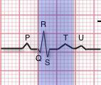 QT/QTc Uzaması ve Ani Ölüm QT ARALIĞI QT Interval QT aralığı, QRS kompleksinin başlangıcından T