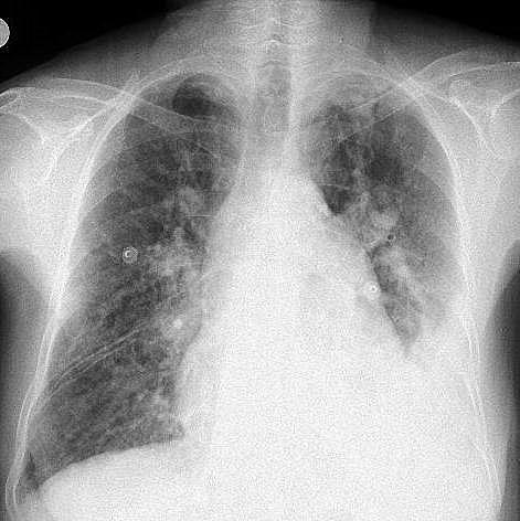 kontralateral ya da bilateral olarak akciğerlerde gelişebilir 2. Reekspansiyon pulmoner ödem, uzun süre kollabe kalmış akciğerin tedavisi sırasında ortaya çıkan bir komplikasyondur.