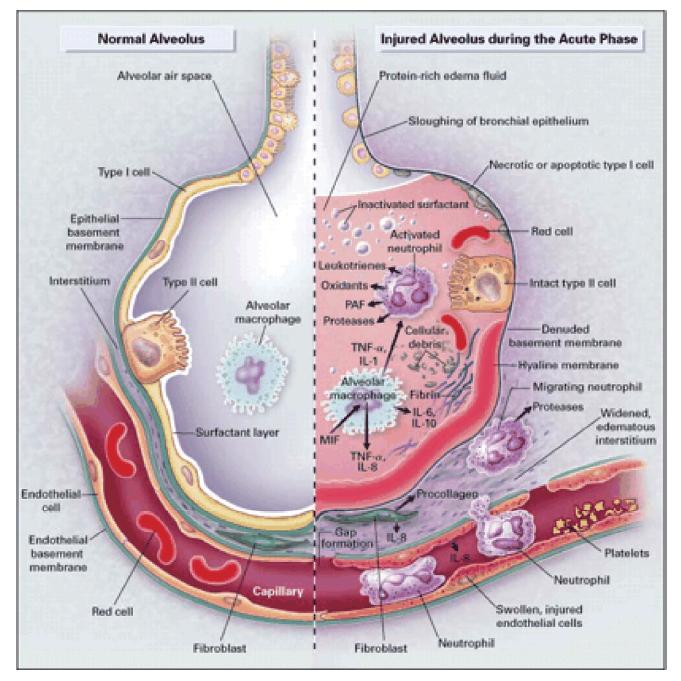 Tanımlar Postpnömonektomi Pulmoner Ödem Düşük basınç veya permeabilite pulmoner ödemi Postopera;f Akciğer Hasarı Son