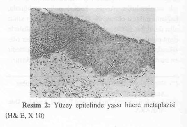 Cinsiyet açısından çeşitli serilerdeki oranlarda bir miktar farklılık izlenmekle beraber, iki seriden örnek vermek gerekirse, Cook ve akradaşlarının (5) yaptığı çalışmada erkekkadın oranı 2.