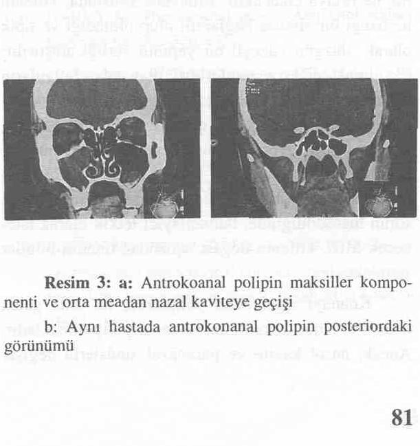 K.B.B. ve Baş Boyun Cerrahisi Dergisi, 7999, 7 (2): 79-84, Dr. S. Sabri USLU ve ark.