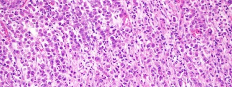 a) Taşlı yüzük hücreli karsinom. Üst tarafta tümör dışı gastrik mukoza izleniyor.