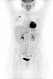 patolojik düzeyde aktivite tutulumu bulunmayan PET/BT MIP görüntüsü.
