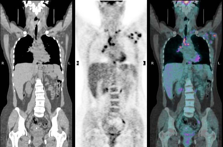 A B C Resim 4: 36 yaşında bayan hasta, sol memede kitle nedeniyle yapılan biyopsi sonucu meme kanseri tanısı almış olup operasyon öncesi yapılan PET/BT incelemesinde A: Tüm vücut BT görüntüsü, B: Tüm