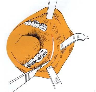 8 Sagittal split ramus osteotominin günümüzde en sık tercih edilen osteotomi olmasının nedenleri (Proffit ve ark., s.: 313).: 1. Distal segmentin rahat pozisyonlandırılabilmesi, 2.