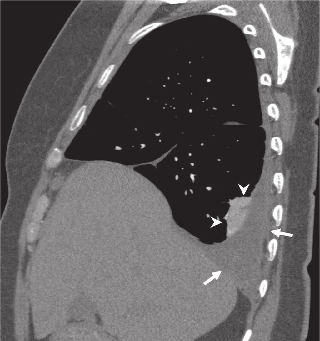 Pulmoner emboli saptanmayan 197 olgunun 154 ünde ( %78.