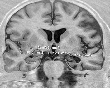 Neurology belirtilen kriterlere uygun olarak MTLE-HS tanısı alan, 14 sol MTLE-HS li, 14 sağ MTLE-HS li toplam 28 hasta ve 36 sağlıklı kontrol grubu olmak üzere toplam 64 kişi dâhil edildi.