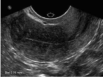 Resim 2. Postmenopozal atrofik endometrium (22) Tablo 2.