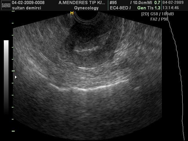 (Resim 4) (74) Doppler USG tanı sensitivitesi %95 ve spesifisitesi %80 dir (24). Timmerman ve ark. tek besleyen damar bulgusunun endometrial polip için %76.4 sensitivite, %95.