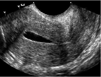 A Resim 7. Normal endometrial kavite SĠS görüntüsü (A; 22