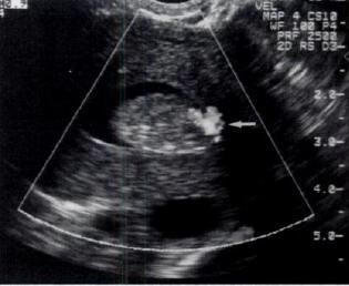 Endometrial poliplerin SĠS deki tipik görüntüleri; iyi sınırlı, homojen,