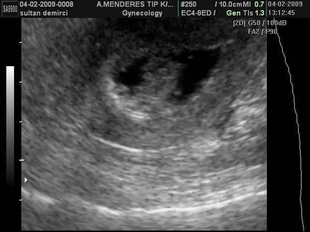 endometrial kalınlık ölçülebilir (10,8). Resim 10. Endometrial polip (96) Resim 11.