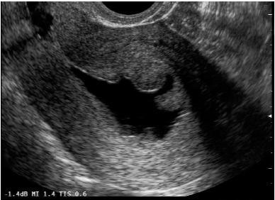 c) Endometrial Hiperplazi ve Kanser Endometrial hiperplazi SĠS de endometrial kalınlaģma olarak saptanır. Diffüz veya fokal olarak gözlenebilir (24). (Resim 17) (128) Sergio ve ark.