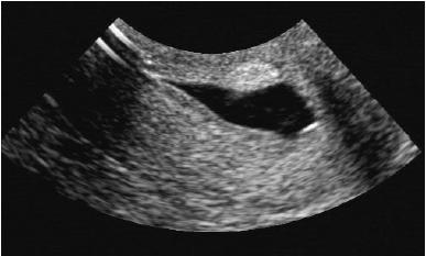 Ancak SĠS endometrial hiperplazi tiplerinin ve endometrial kanser ayrımında yetersizdir (23). A B Resim 17. Diffüz (A) ve fokal (B) endometrial hiperplazi SĠS görüntüsü (128).