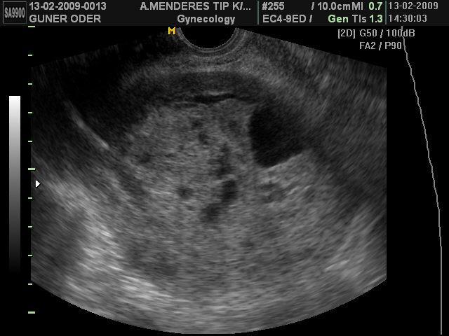 Endometrial malignite Renkli Doppler SĠS görüntüsü (68). Valenzano ve ark.