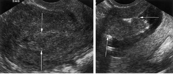 1.3.B.4.G. Rezidüel Gebelik Ürünü Görüntülemesi Wolman ve ark SĠS in uterin kavite içerisinde kalmıģ konsepsiyon materyalinin tanı ve evakuasyonunda kullanılmasını önermektedirler (166).