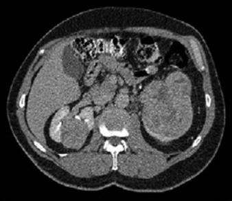 nefrektomi uygulandı (Şekil 2). Üç hastada (%16) majör peroperatif ve 2 hastada (%11) minör yara komplikasyonu saptandı. Bir hastada retroperitoneal nüks sonrası yaygın peroperatif kanama görüldü.