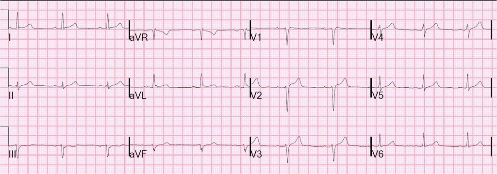 Acildeki EKG R progresyonu az, ST elevasyonu azalmış.