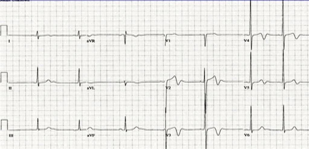 EKG 4 gün