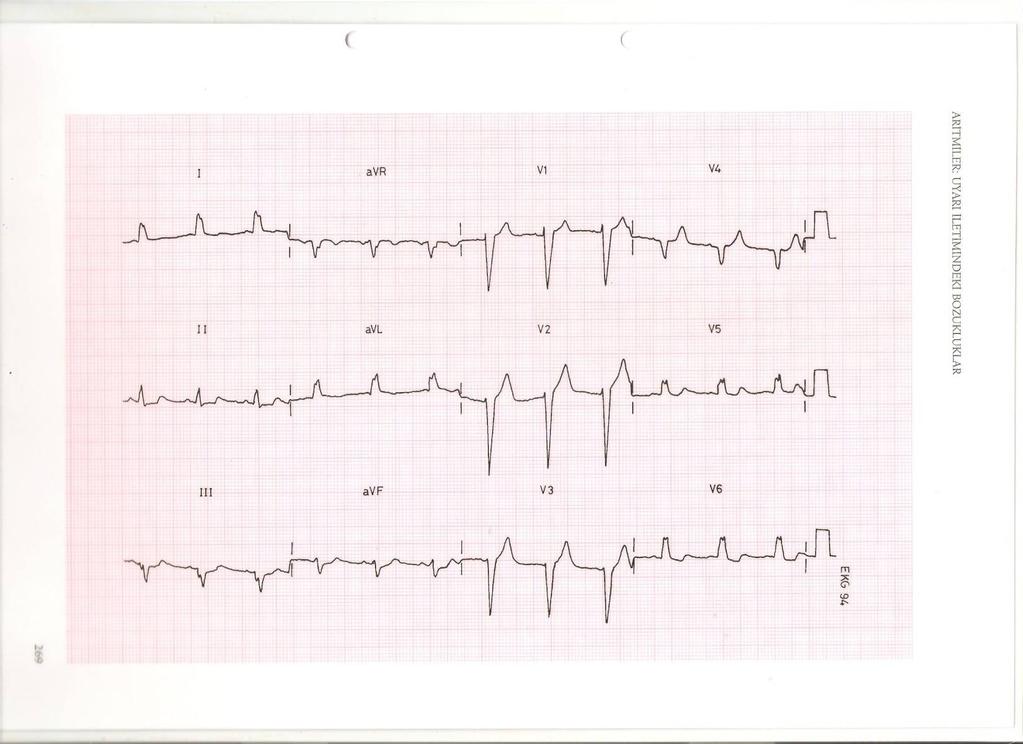 LBBB