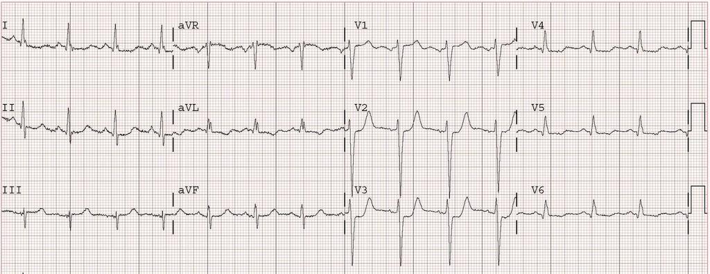 EKG