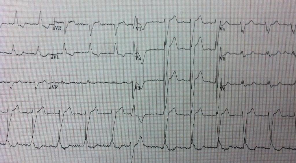 EKG