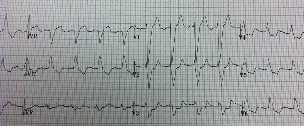 5 dakika sonra şiddetli göğüs ağrısı olur çekilen EKG V2-3 konkordant ST depresyonu, V4 ST