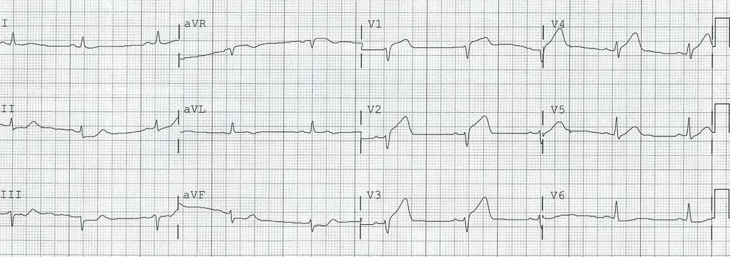 EKG 19:44