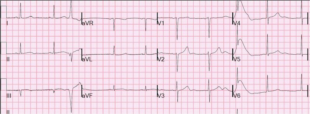 EKG 1