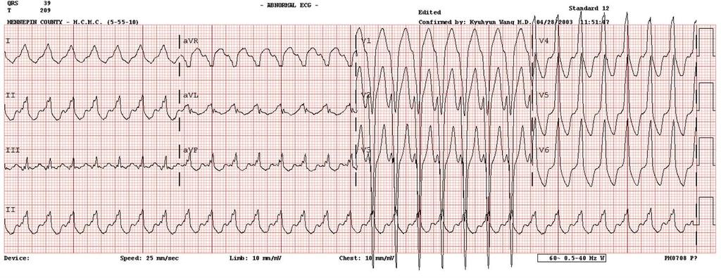 EKG P dalgaları yok, Düzenli