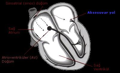 WPW sendromu Preeksitasyon sendromu, aksesuar yol.. Kısa PR, Delta dalgası, Ortodromik (AEV AVN-Hispurkinje Aks.