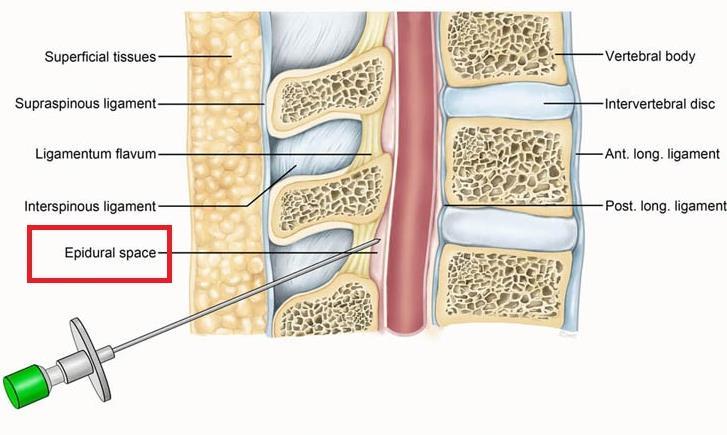 15 2.3.2. Epidural Boşluk Epidural boşluk, dural kılıf ile spinal kanal arasında bir anatomik kompartman olarak ilk kez 1901 de tanımlanmıştır (77). 2.3.2.1. Epidural Boşluğun Sınırları Superior sınırı: Foramen magnum seviyesinde dura materin spinal ve periostal katmanlarının füzyonu.