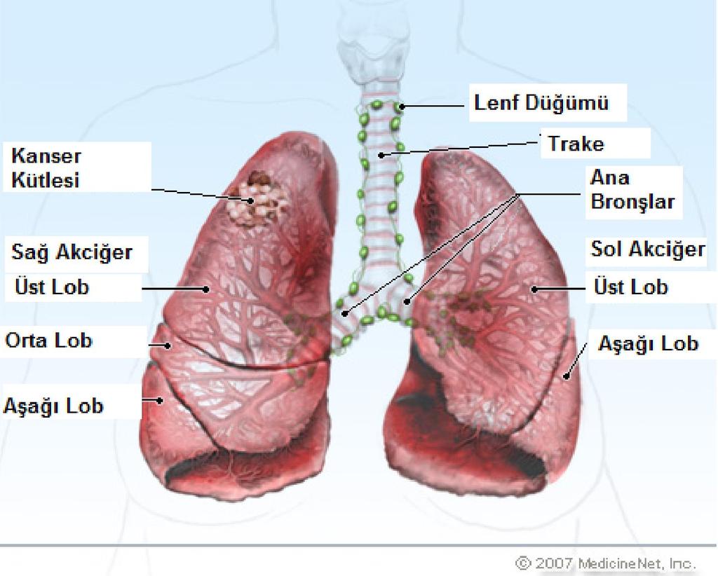 2.3. Akciğer Kanseri Akciğer kanseri dünya genelinde en sık görülen ve etkisi her geçen yıl % 0,5 oranında artan epidemik hastalıktır.